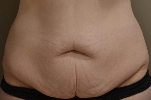 Tummy Tuck Before & After Gallery - Patient 316848 - Image 1