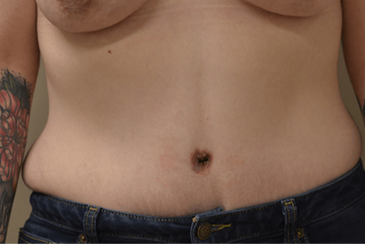 Tummy Tuck Before & After Gallery - Patient 316848 - Image 2