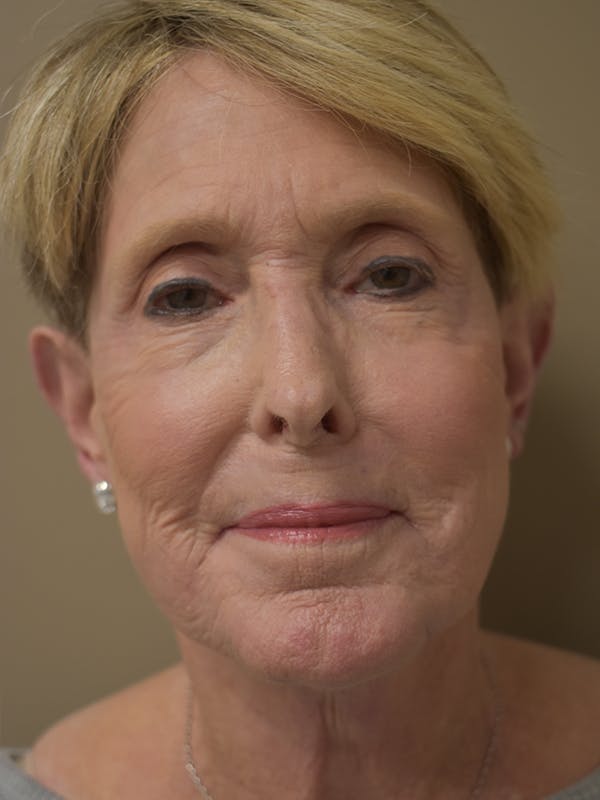 Co2 Laser Resurfacing Before & After Gallery - Patient 291602 - Image 2