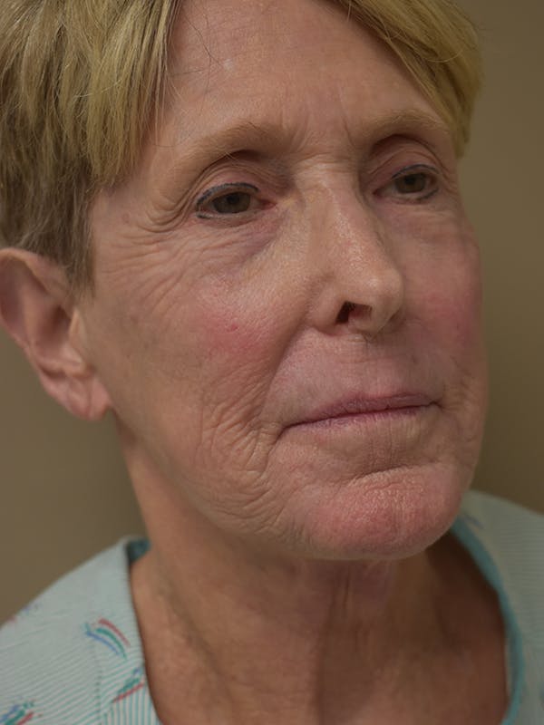 Co2 Laser Resurfacing Before & After Gallery - Patient 291602 - Image 5