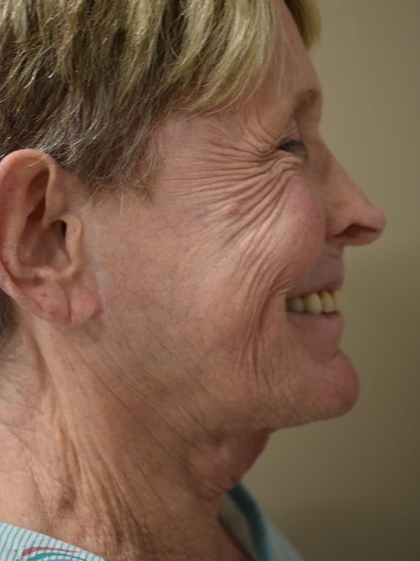 Co2 Laser Resurfacing Before & After Gallery - Patient 291602 - Image 7