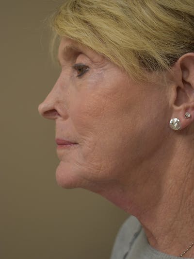 Co2 Laser Resurfacing Before & After Gallery - Patient 291602 - Image 10
