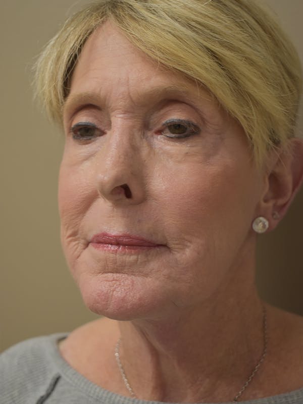 Co2 Laser Resurfacing Before & After Gallery - Patient 291602 - Image 12