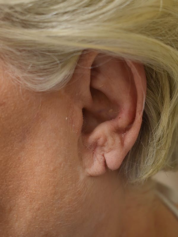 Otoplasty Before & After Gallery - Patient 201170 - Image 3