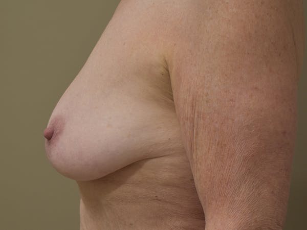 Breast Lift Before & After Gallery - Patient 420738 - Image 5