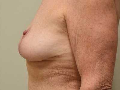 Breast Lift Before & After Gallery - Patient 420738 - Image 6
