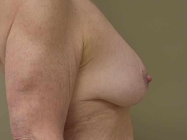 Breast Lift Before & After Gallery - Patient 420738 - Image 7