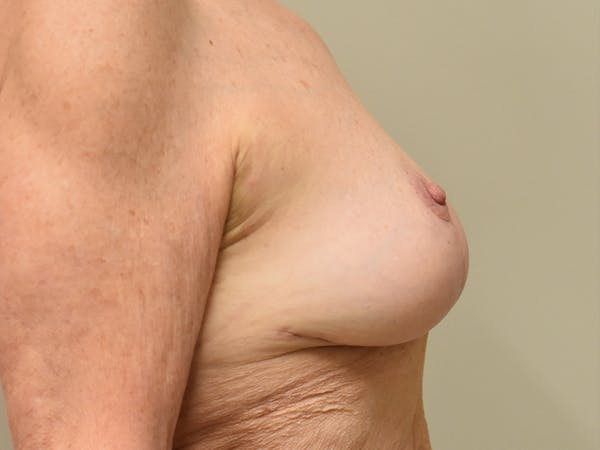 Breast Lift Before & After Gallery - Patient 420738 - Image 8
