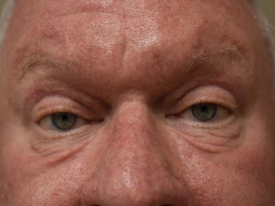 Eyelid Surgery Before & After Gallery - Patient 285541 - Image 2