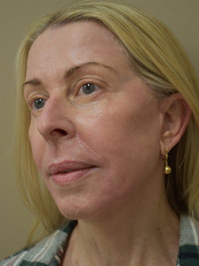 Co2 Laser Resurfacing Before & After Gallery - Patient 522244 - Image 4