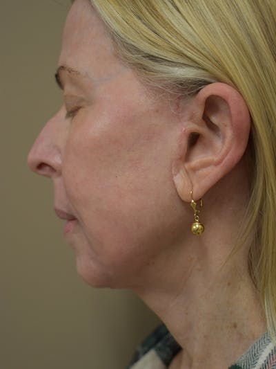 Co2 Laser Resurfacing Before & After Gallery - Patient 522244 - Image 6