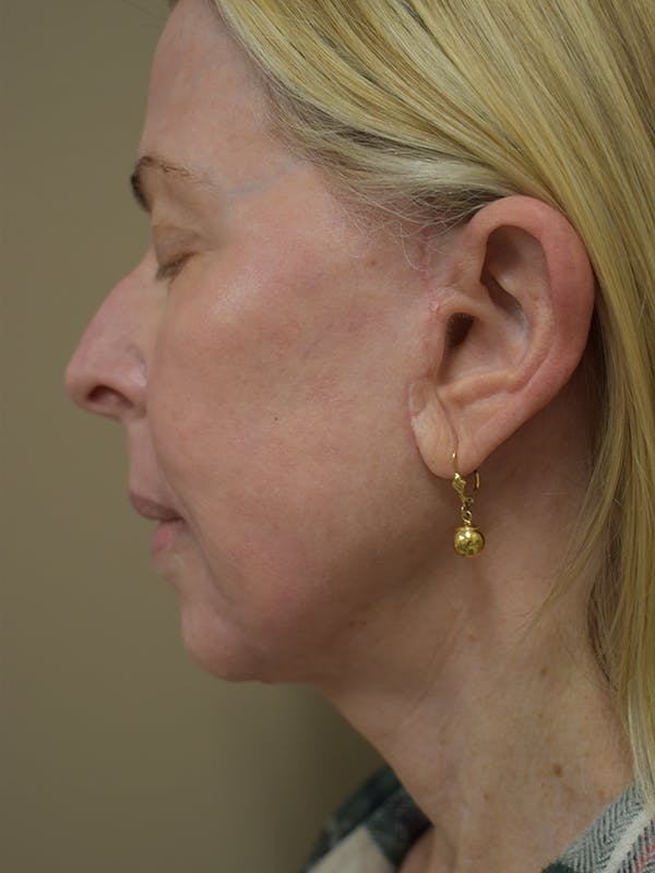 Co2 Laser Resurfacing Before & After Gallery - Patient 522244 - Image 6