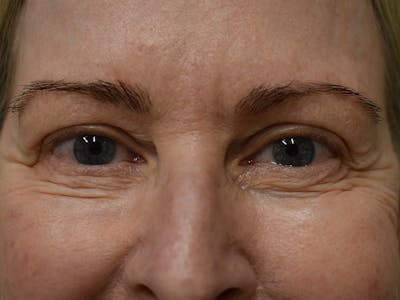 Eyelid Surgery Before & After Gallery - Patient 360710 - Image 1