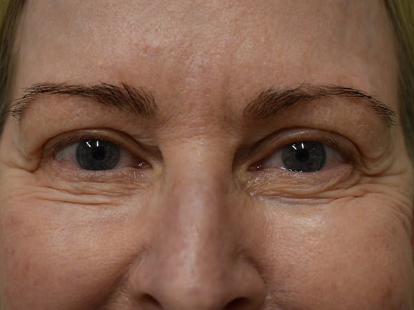 Co2 Laser Resurfacing Before & After Gallery - Patient 522244 - Image 7
