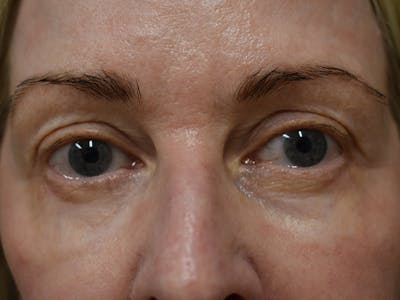 Eyelid Surgery Before & After Gallery - Patient 360710 - Image 2