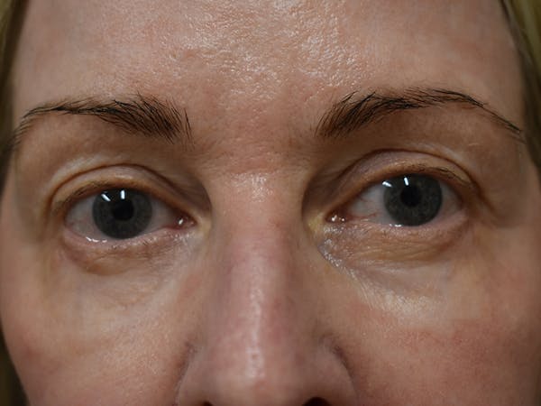 Co2 Laser Resurfacing Before & After Gallery - Patient 522244 - Image 8