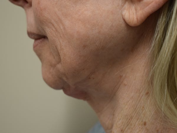 Co2 Laser Resurfacing Before & After Gallery - Patient 522244 - Image 11