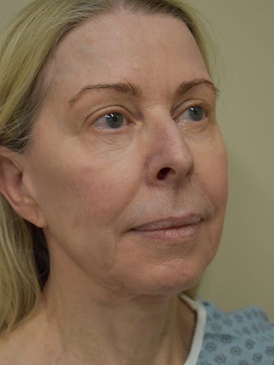 Co2 Laser Resurfacing Before & After Gallery - Patient 522244 - Image 1