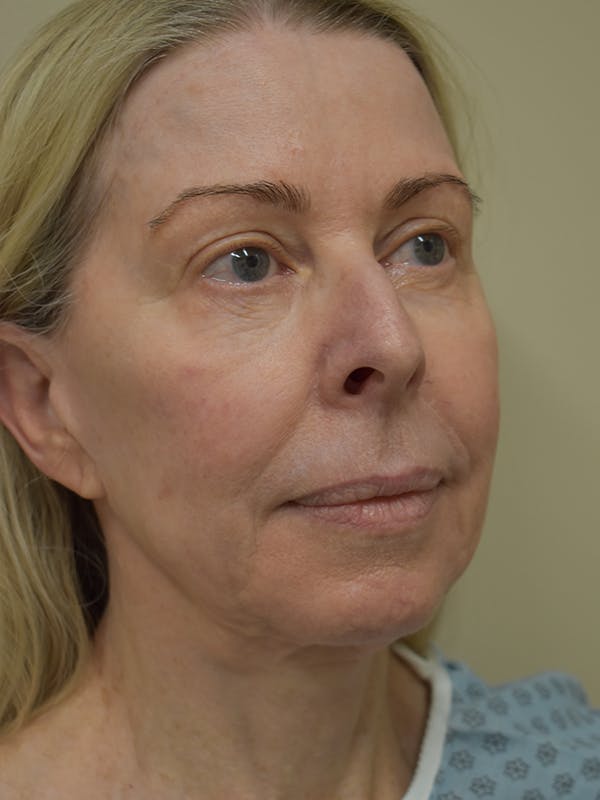 Co2 Laser Resurfacing Before & After Gallery - Patient 522244 - Image 1