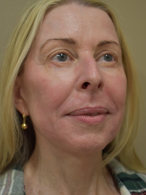 Co2 Laser Resurfacing Before & After Gallery - Patient 522244 - Image 2