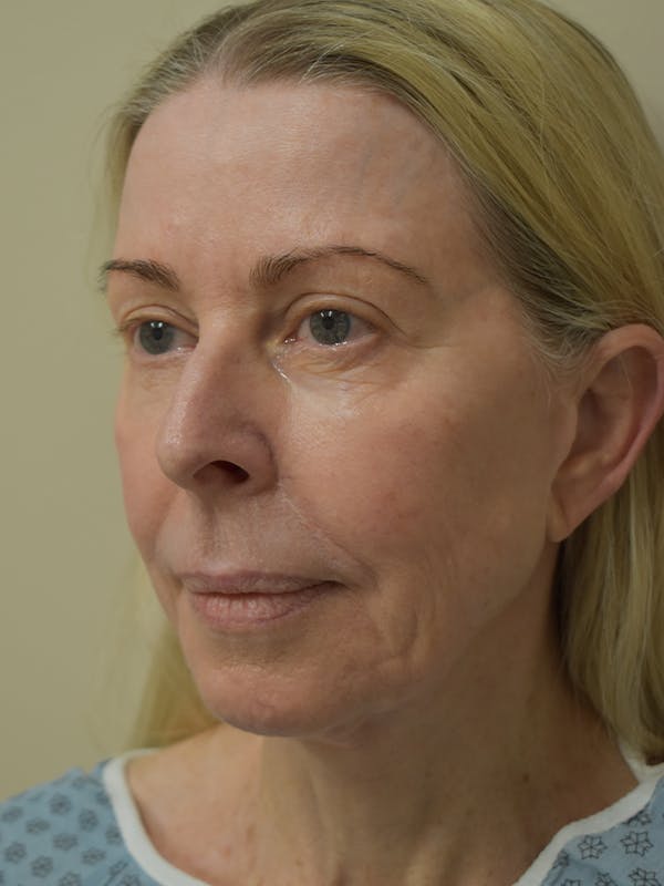 Co2 Laser Resurfacing Before & After Gallery - Patient 522244 - Image 3