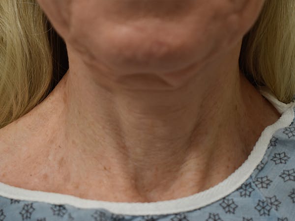 Co2 Laser Resurfacing Before & After Gallery - Patient 522244 - Image 9