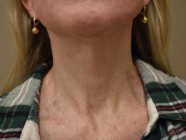 Co2 Laser Resurfacing Before & After Gallery - Patient 522244 - Image 10