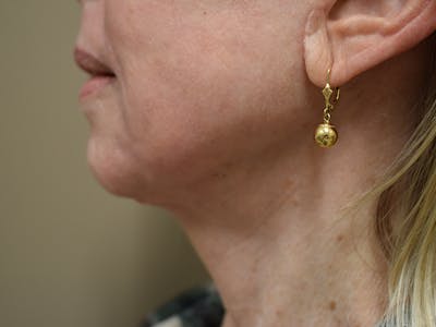 Co2 Laser Resurfacing Before & After Gallery - Patient 522244 - Image 12
