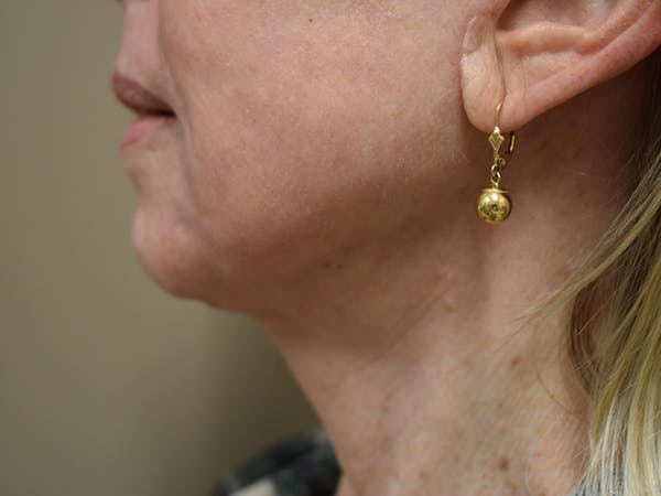 Co2 Laser Resurfacing Before & After Gallery - Patient 522244 - Image 12