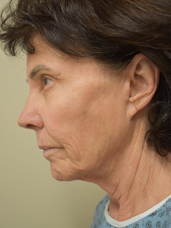 Facelift Before & After Gallery - Patient 184223 - Image 3