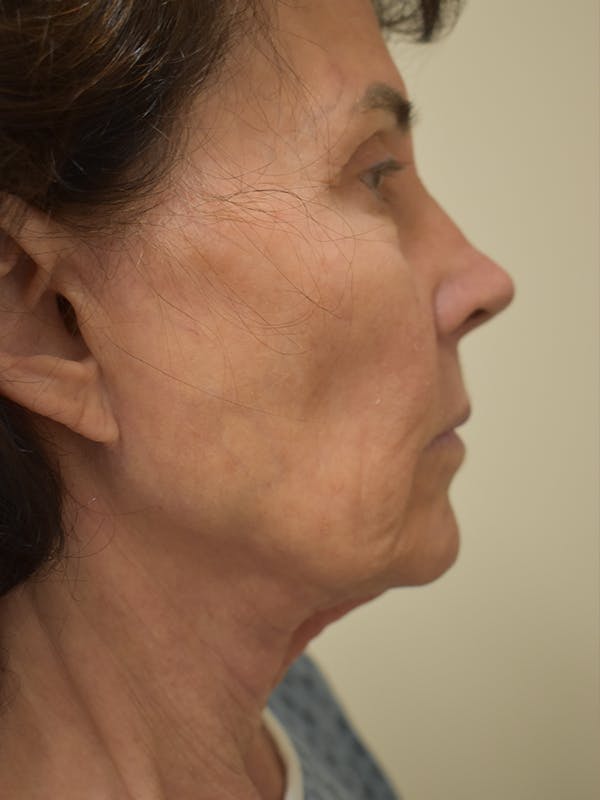 Facelift Before & After Gallery - Patient 184223 - Image 5