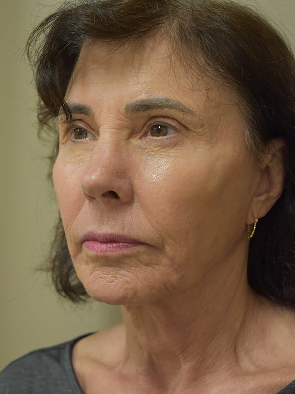 Facelift Before & After Gallery - Patient 184223 - Image 2