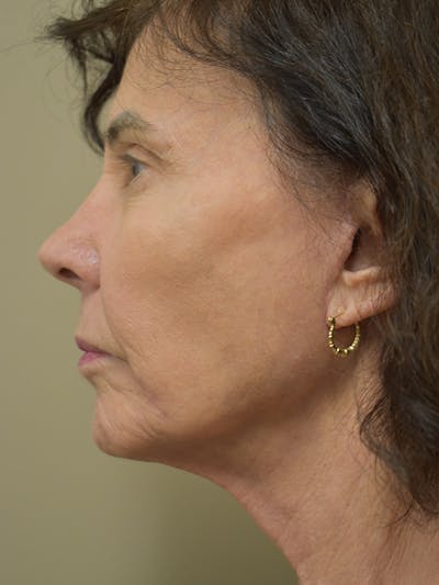 Facelift Before & After Gallery - Patient 184223 - Image 4