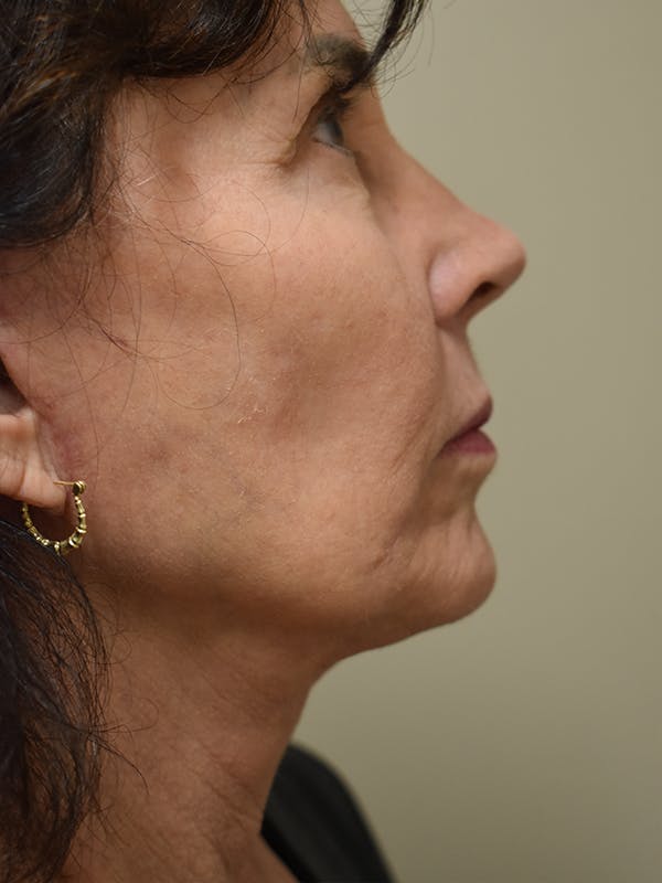 Facelift Before & After Gallery - Patient 184223 - Image 6