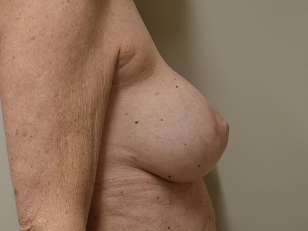 Breast Reconstruction Before & After Gallery - Patient 402962 - Image 8