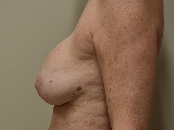 Breast Reconstruction Before & After Gallery - Patient 402962 - Image 9