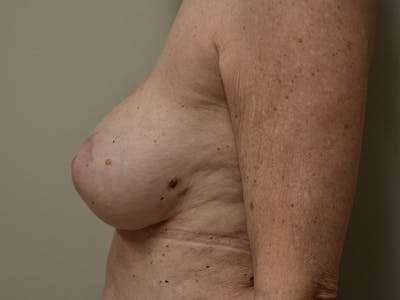 Breast Reconstruction Before & After Gallery - Patient 402962 - Image 10