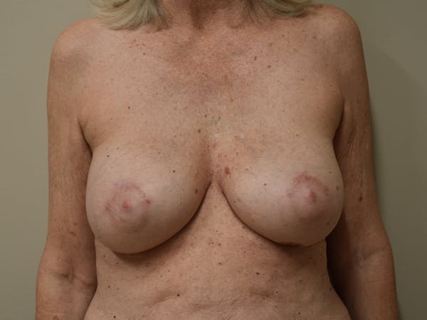 Breast Reconstruction Before & After Gallery - Patient 402962 - Image 2