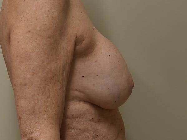 Breast Reconstruction Before & After Gallery - Patient 402962 - Image 7