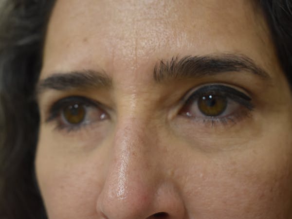 Eyelid Surgery Before & After Gallery - Patient 412131 - Image 2
