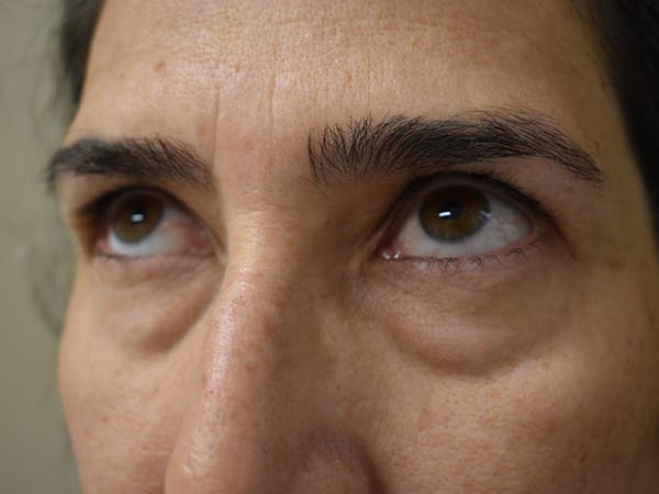 Eyelid Surgery Before & After Gallery - Patient 412131 - Image 1