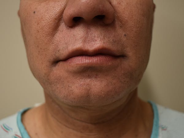 Chin Augmentation Before & After Gallery - Patient 295285 - Image 1