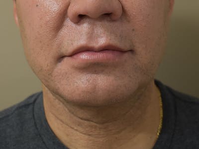 Chin Augmentation Before & After Gallery - Patient 295285 - Image 2