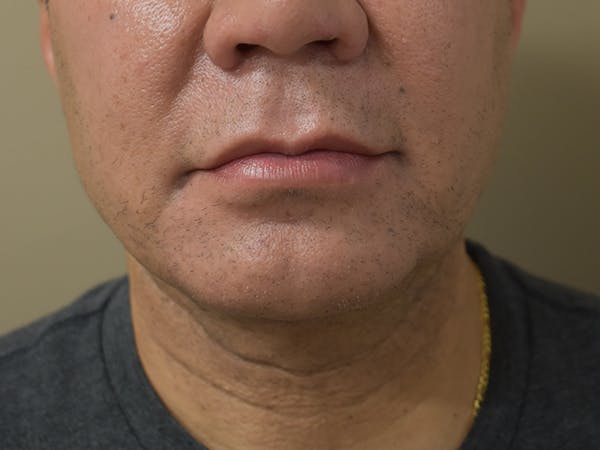 Chin Augmentation Before & After Gallery - Patient 295285 - Image 2