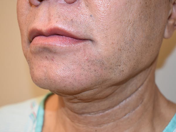 Chin Augmentation Before & After Gallery - Patient 295285 - Image 3