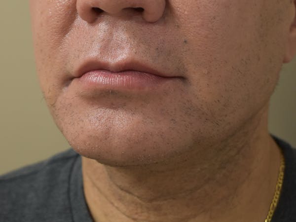 Chin Augmentation Before & After Gallery - Patient 295285 - Image 4