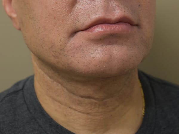 Chin Augmentation Before & After Gallery - Patient 295285 - Image 6