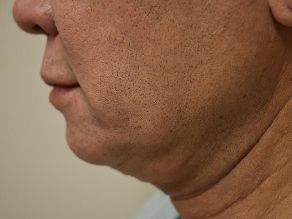 Chin Augmentation Before & After Gallery - Patient 295285 - Image 7