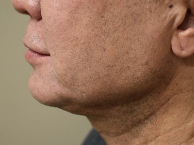 Chin Augmentation Before & After Gallery - Patient 295285 - Image 8