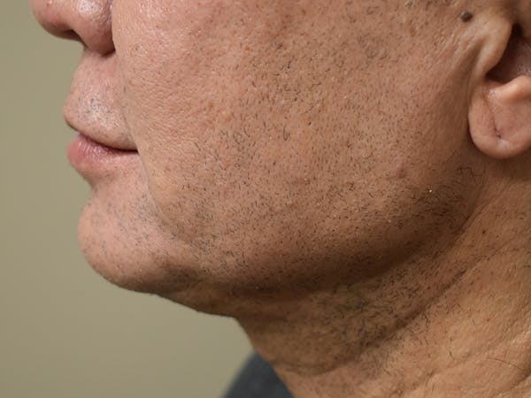 Chin Augmentation Before & After Gallery - Patient 295285 - Image 8